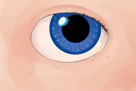 Image titled Down Syndrome Eye.png