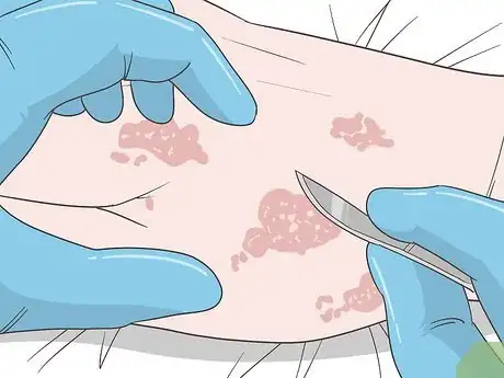 Image titled Stop Scabies Itching Step 8