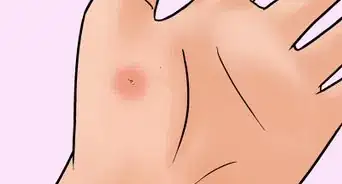 Remove a Pin or Tack from Your Skin