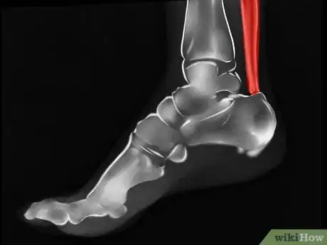 Image titled Diagnose Heel Spurs Step 4