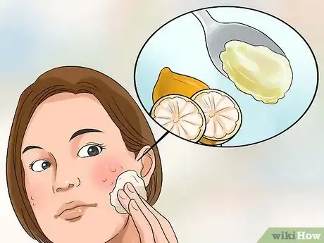 Image titled Clear up Acne With Hydrogen Peroxide Step 6
