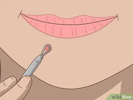 Image titled Get Rid of a Pimple Step 2
