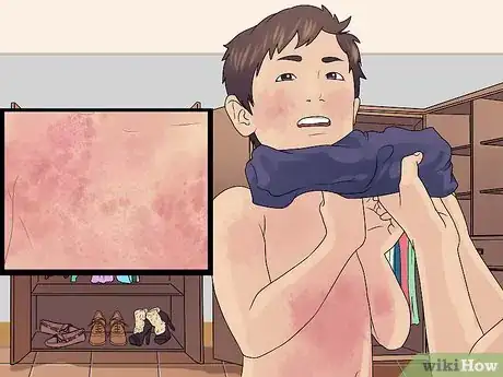Image titled Recognize and Treat Scarlet Fever Step 1