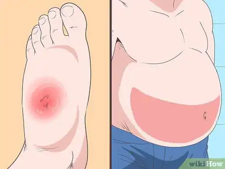 Image titled Treat Liver Disease Step 7