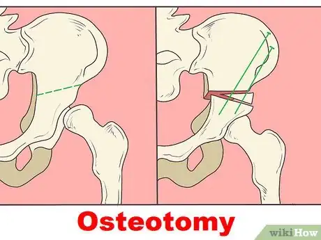 Image titled Treat Hip Arthritis Step 15