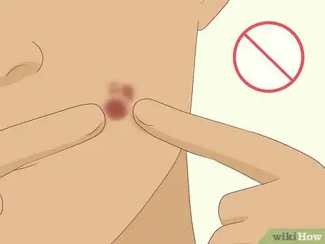 Image titled Prevent Cystic Acne Step 11