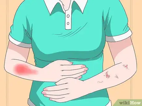 Image titled Recognize Signs and Symptoms of Ebola Step 2