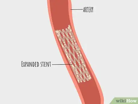 Image titled Treat Atherosclerosis Step 9
