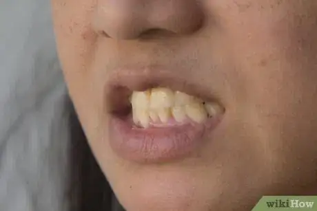 Image titled Whiten Your Teeth with Banana Peel Step 3Bullet2