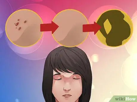 Image titled Become Pregnant With HPV Step 3