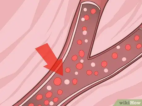 Image titled Diagnose Fanconi Anemia Step 11