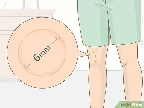 Image titled Prevent Molluscum (Molluscum Contagiosum) Step 7