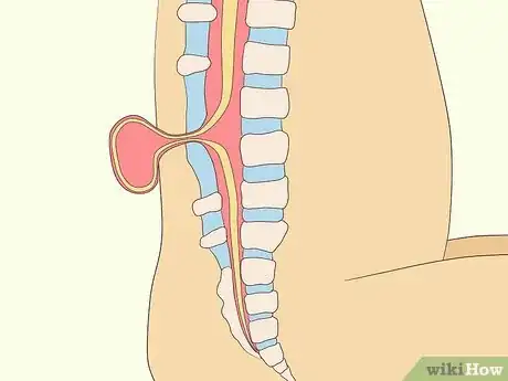 Image titled Treat Neurological Disorders Step 6