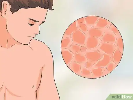 Image titled Treat Itchy Breasts Step 1