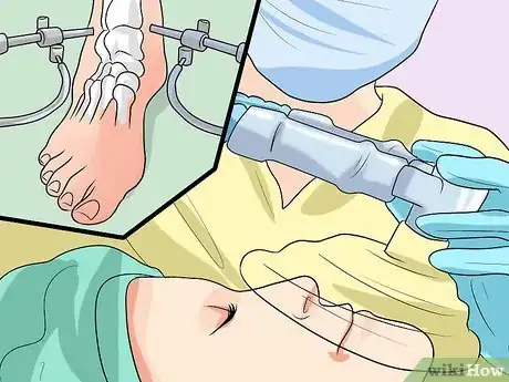 Image titled Treat Post Traumatic Arthritis Step 11