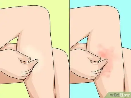 Image titled Know if You Have Sensitive Skin Step 5