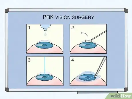 Image titled Know if Laser Vision Surgery Is Right for You Step 10