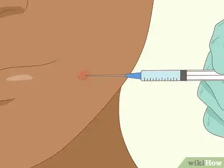 Image titled Avoid Blind Pimples Step 10