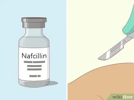 Image titled Diagnose Infective Endocarditis Step 8