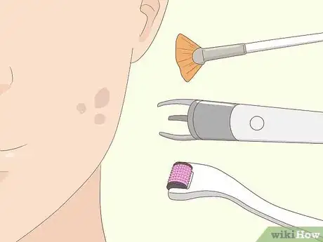 Image titled Prevent Cystic Acne Step 13