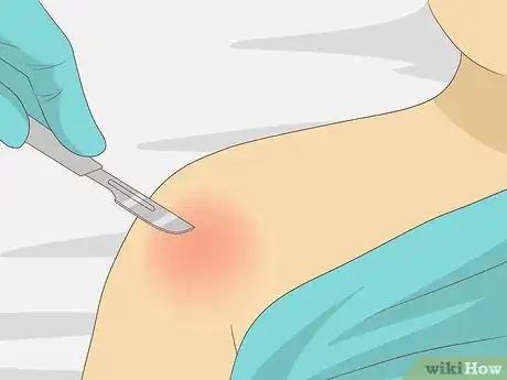 Image titled Identify a Rotator Cuff Injury Step 16