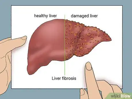 Image titled Diagnose Liver Fibrosis Step 1