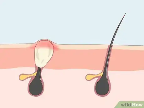 Image titled Treat Adult Acne Step 1