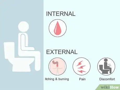 Image titled Get Rid of Hemorrhoids Fast Step 2