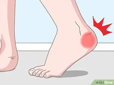 Image titled Treat Both Psoriatic Arthritis and Psoriasis Step 15