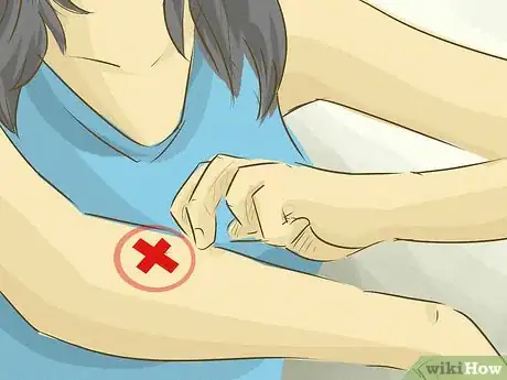 Image titled Stop Scratching a Mosquito Bite Step 1