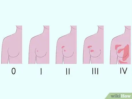 Image titled Diagnose Breast Cancer Step 11