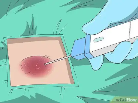 Image titled Diagnose Sarcoma Step 12