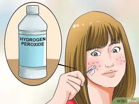 Image titled Clear up Acne With Hydrogen Peroxide Step 3