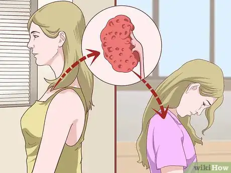Image titled Treat Autosomal Dominant Polycystic Kidney Disease Step 2