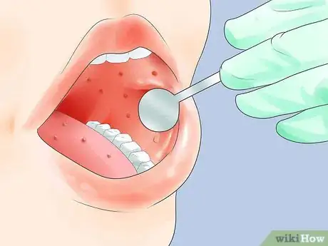 Image titled Diagnose Measles Step 3