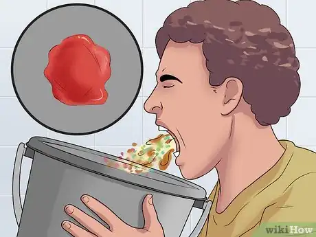 Image titled Test for Upper Gastrointestinal Bleeding Step 1