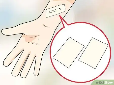 Image titled Prevent Keloid and Hypertrophic Scars Step 5