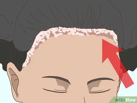 Image titled Treat Both Psoriatic Arthritis and Psoriasis Step 18