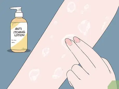 Image titled Stop Scabies Itching Step 1