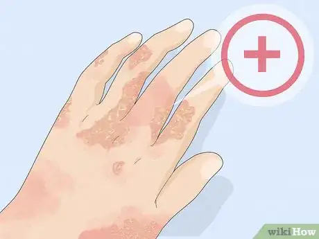 Image titled Use Aloe Vera to Treat Eczema Step 8