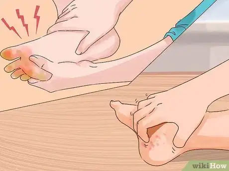 Image titled Treat Trench Foot Step 1