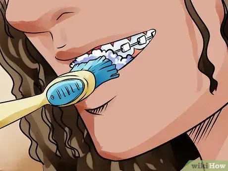 Image titled Apply Dental Wax on Braces Step 6