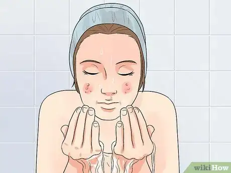 Image titled Get Rid of Acne if You Have Fair Skin Step 14