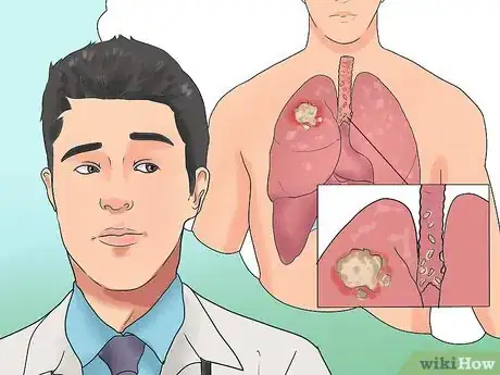 Image titled Stage Lung Cancer Step 9