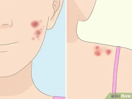 Image titled Prevent Cystic Acne Step 2