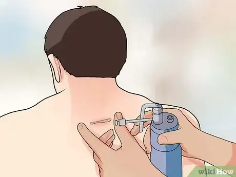 Image titled Prevent Keloid and Hypertrophic Scars Step 10