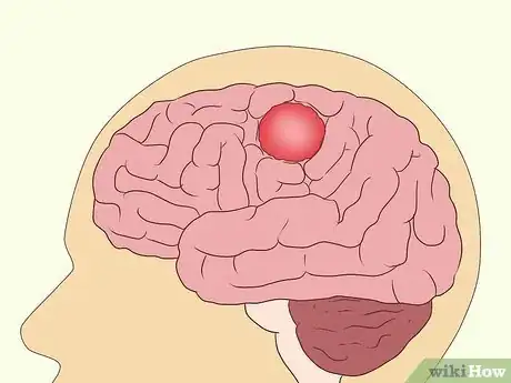 Image titled Treat Neurological Disorders Step 9