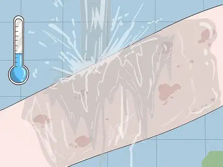 Image titled Stop Scabies Itching Step 2