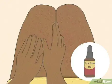 Image titled Get Rid of Razor Burn Fast Step 10