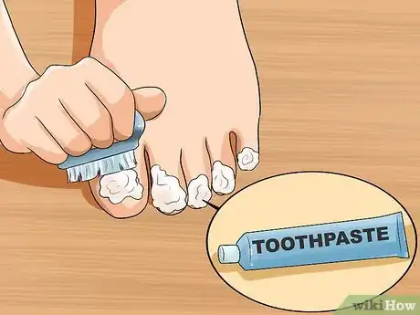 Image titled Get Rid of Yellow Toenails Step 14